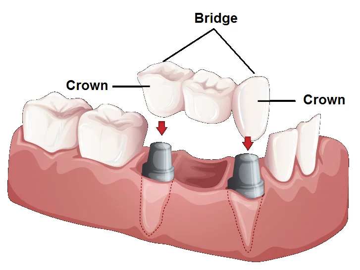 Dental Crown/Cap