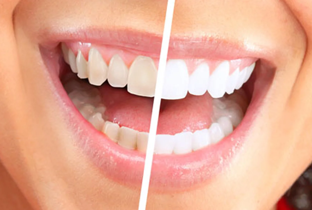 Teeth Whitening