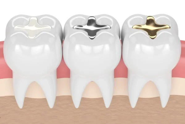 Dental Fillings