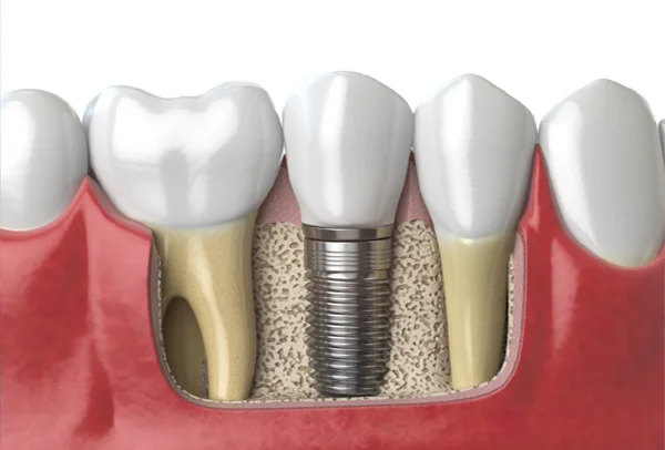 Dental Implant