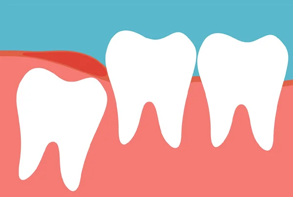 Wisdom Teeth Extraction